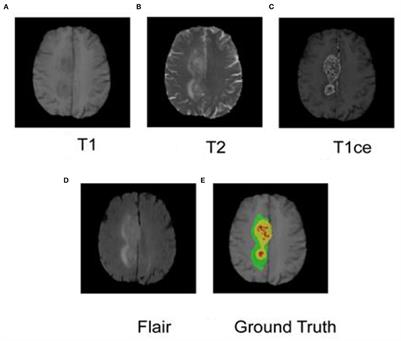 Survival prediction for patients with glioblastoma multiforme using a Cox proportional hazards denoising autoencoder network